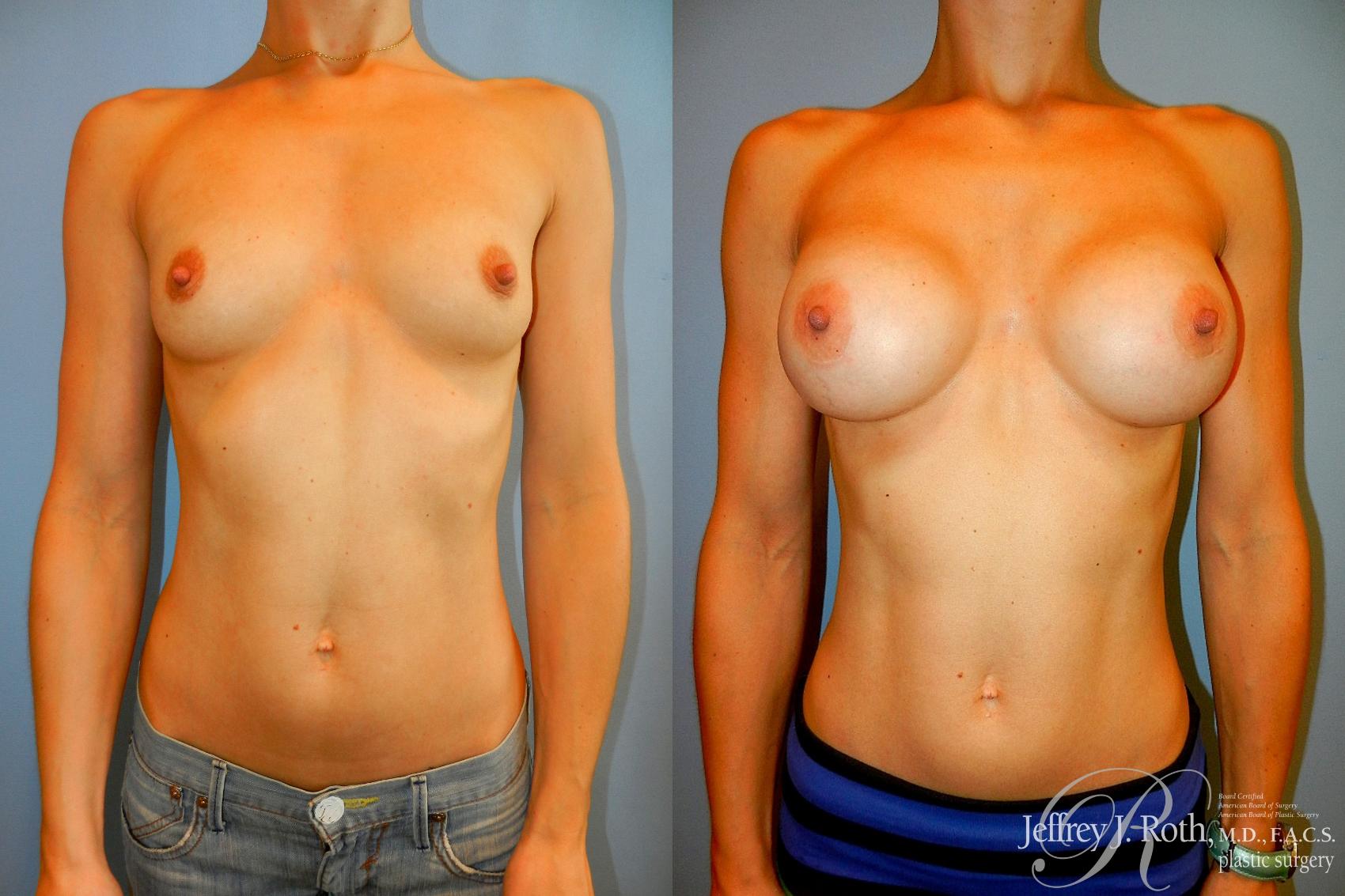 Before & After Breast Augmentation Case 216 Front View in Las Vegas and Henderson, NV