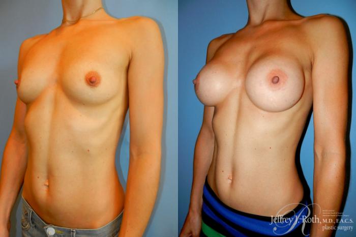 Before & After Breast Augmentation Case 216 Left Oblique View in Las Vegas and Henderson, NV