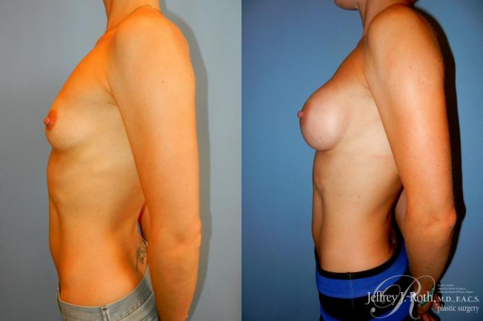 Before & After Breast Augmentation Case 216 Left Side View in Las Vegas and Henderson, NV