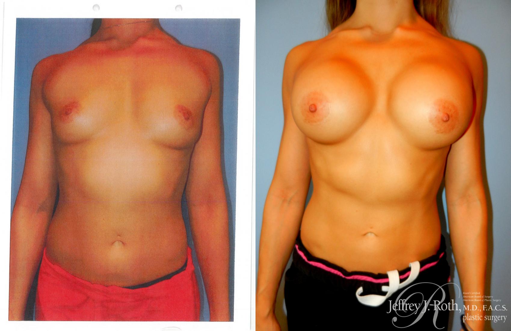 Before & After Breast Augmentation Case 218 Front View in Las Vegas, NV