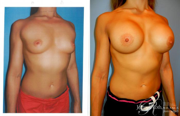 Before & After Breast Augmentation Case 218 Right Side View in Las Vegas and Henderson, NV