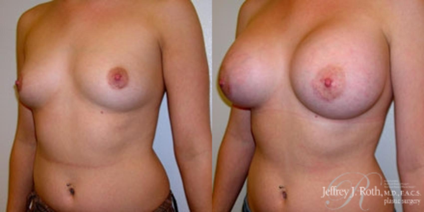 Before & After Breast Augmentation Case 219 Left Oblique View in Las Vegas, NV