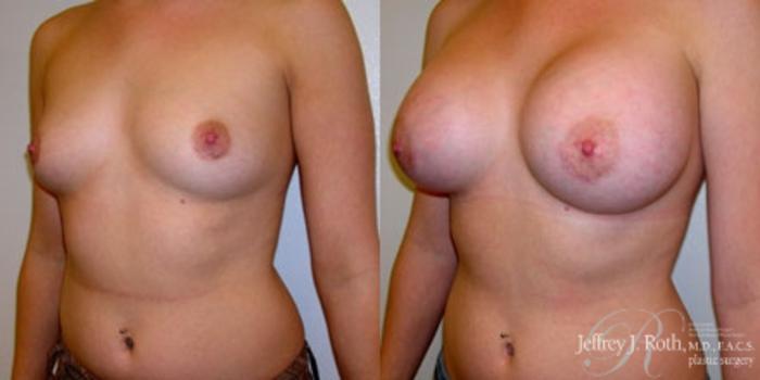 Before & After Breast Augmentation Case 219 Left Oblique View in Las Vegas and Henderson, NV