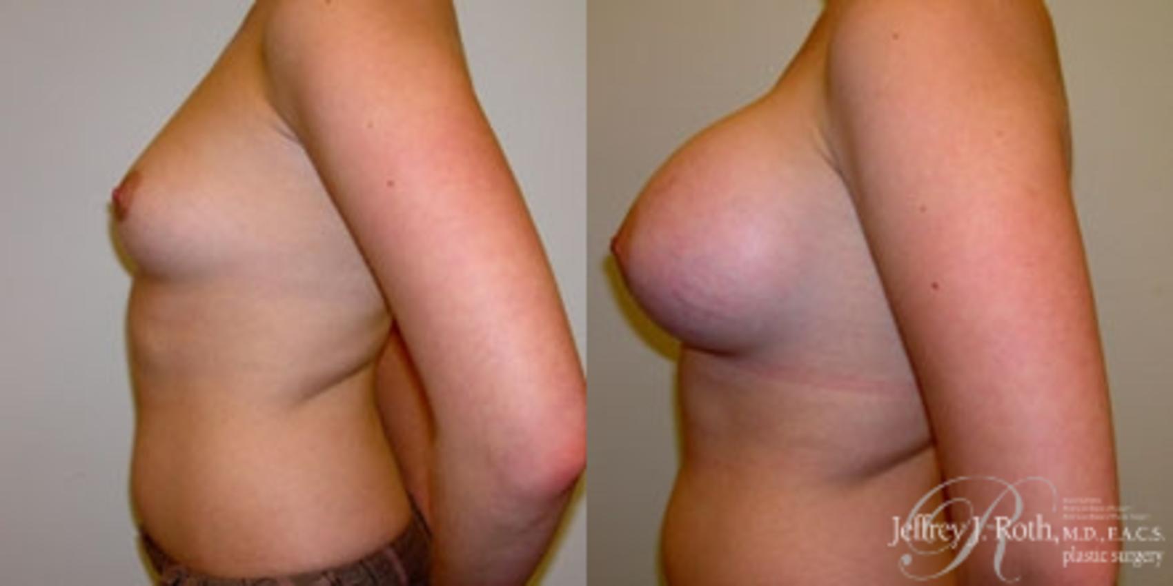 Before & After Breast Augmentation Case 219 Left Side View in Las Vegas, NV