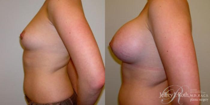 Before & After Breast Augmentation Case 219 Left Side View in Las Vegas and Henderson, NV