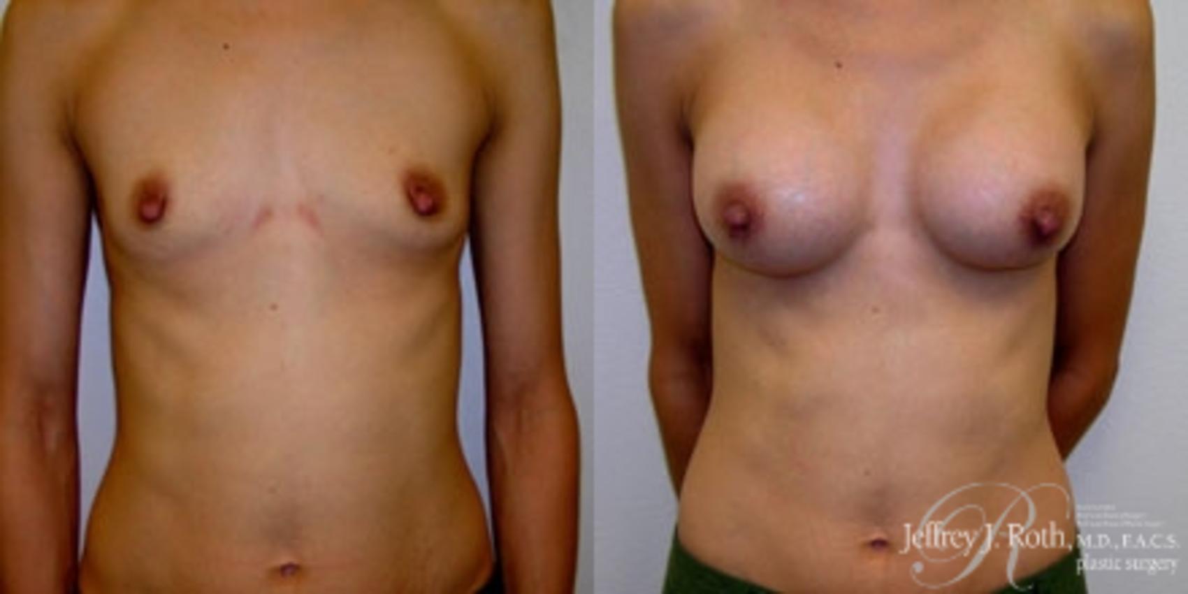 Before & After Breast Augmentation Case 220 Front View in Las Vegas, NV