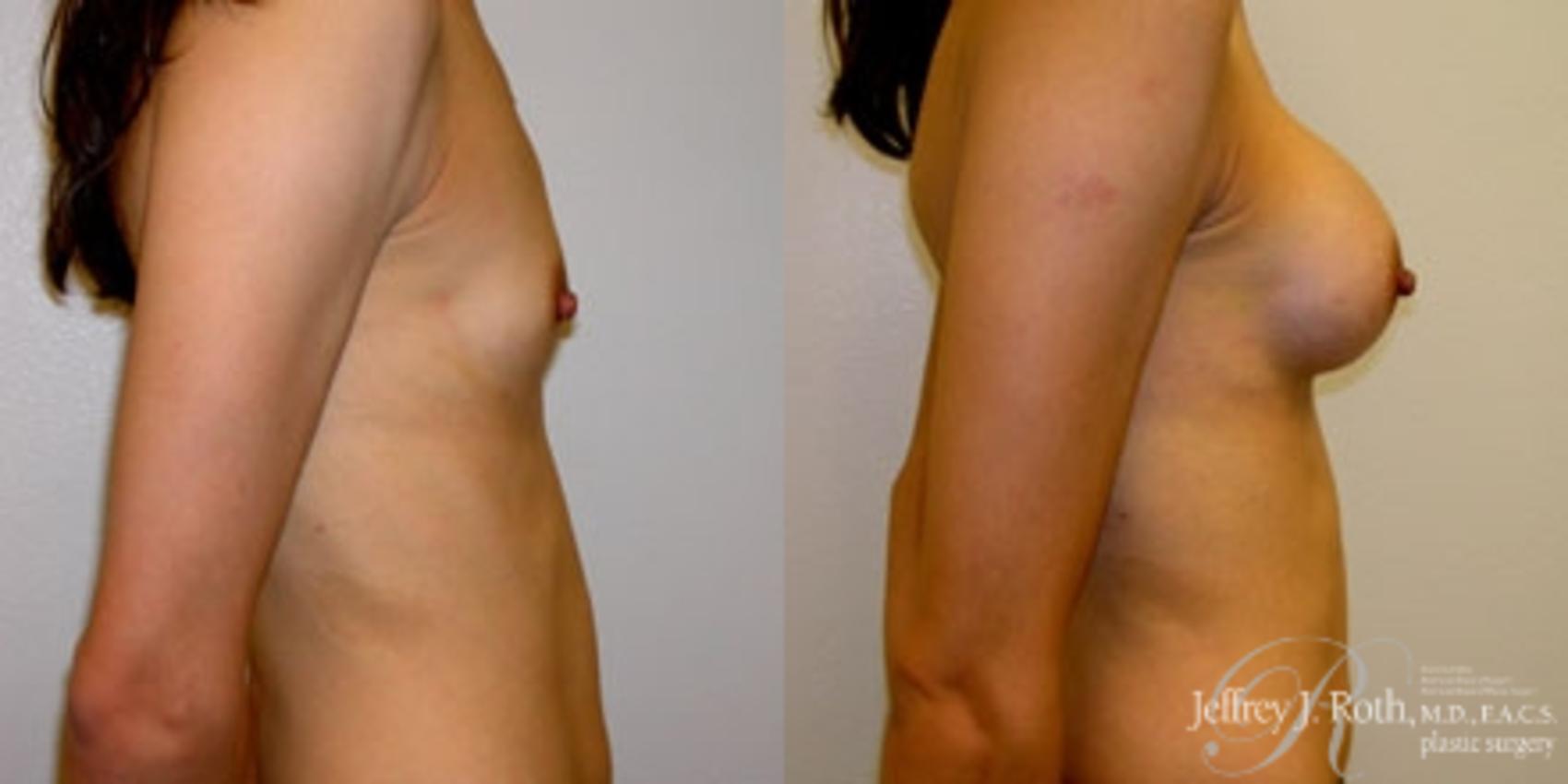Before & After Breast Augmentation Case 220 Right Side View in Las Vegas, NV