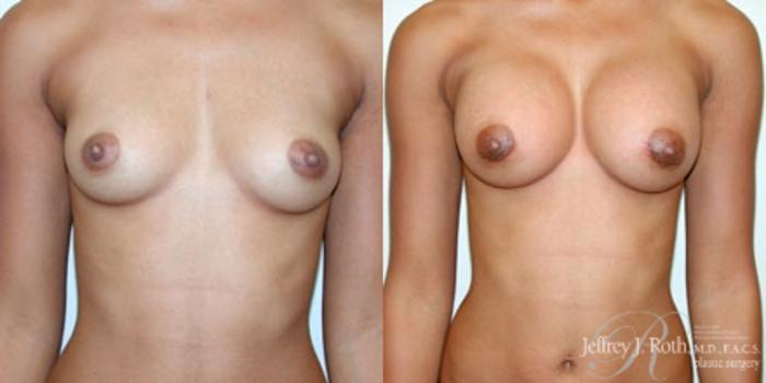 Before & After Breast Augmentation Case 221 Front View in Las Vegas and Henderson, NV