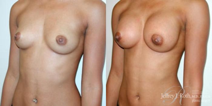 Before & After Breast Augmentation Case 221 Left Oblique View in Las Vegas and Henderson, NV