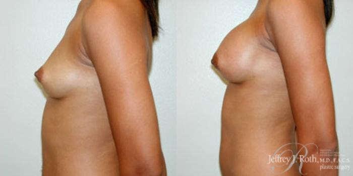 Before & After Breast Augmentation Case 221 Left Side View in Las Vegas and Henderson, NV