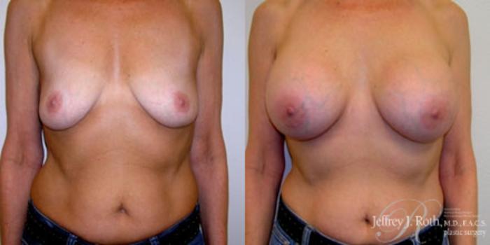 Before & After Breast Augmentation Case 222 Front View in Las Vegas and Henderson, NV