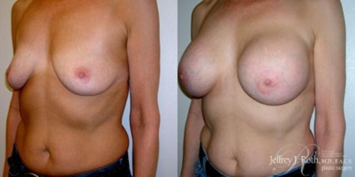 Before & After Breast Augmentation Case 222 Left Oblique View in Las Vegas and Henderson, NV