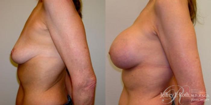 Before & After Breast Augmentation Case 222 Left Side View in Las Vegas and Henderson, NV