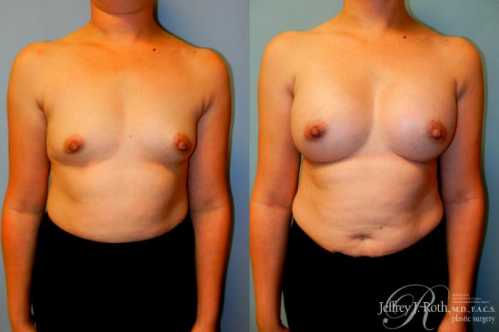 Before & After Breast Augmentation Case 225 Front View in Las Vegas and Henderson, NV