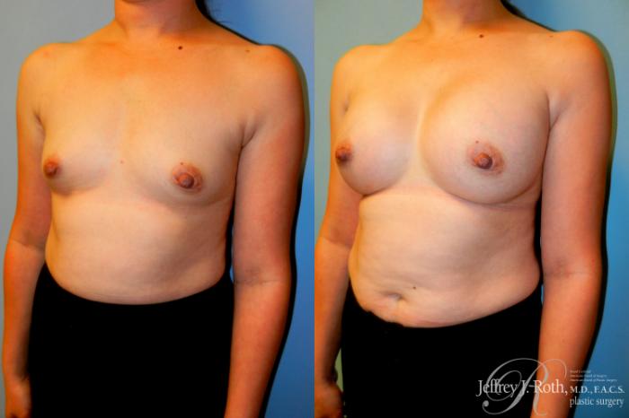 Before & After Breast Augmentation Case 225 Left Oblique View in Las Vegas and Henderson, NV