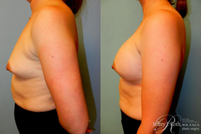 Before & After Breast Augmentation Case 225 Left Side View in Las Vegas and Henderson, NV