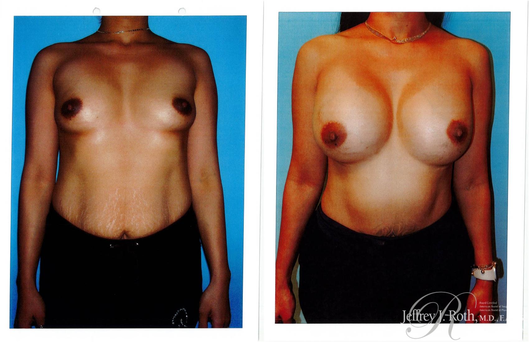 Before & After Breast Augmentation Case 232 Front View in Las Vegas, NV