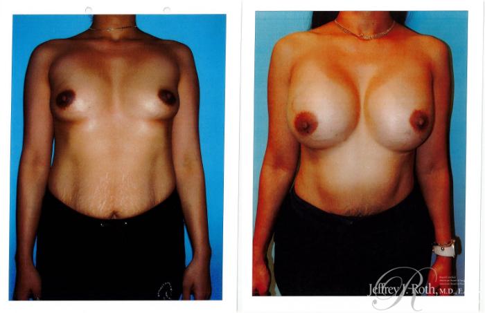 Before & After Breast Augmentation Case 232 Front View in Las Vegas and Henderson, NV