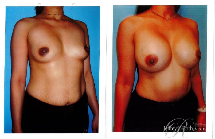 Before & After Breast Augmentation Case 232 Right Oblique View in Las Vegas and Henderson, NV