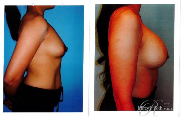 Before & After Breast Augmentation Case 232 Right Side View in Las Vegas and Henderson, NV