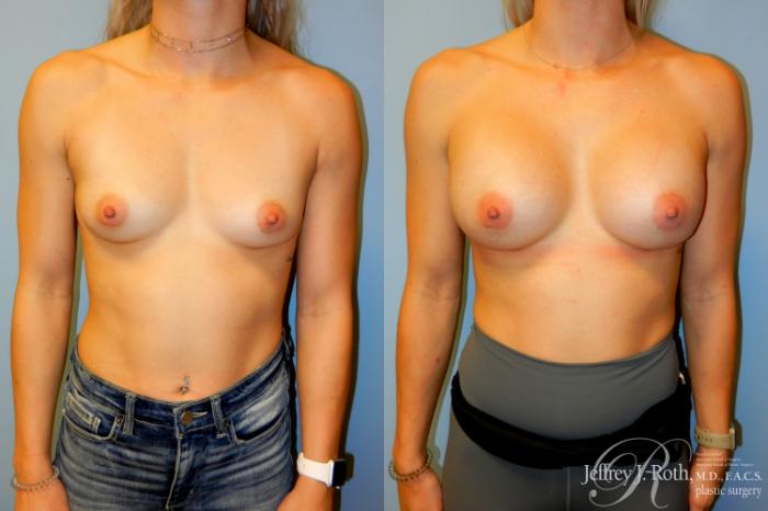 Before & After Breast Augmentation Case 239 Front View in Las Vegas, NV