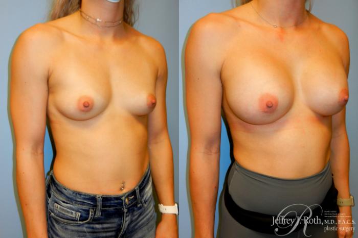 Before & After Breast Augmentation Case 239 Right Oblique View in Las Vegas, NV