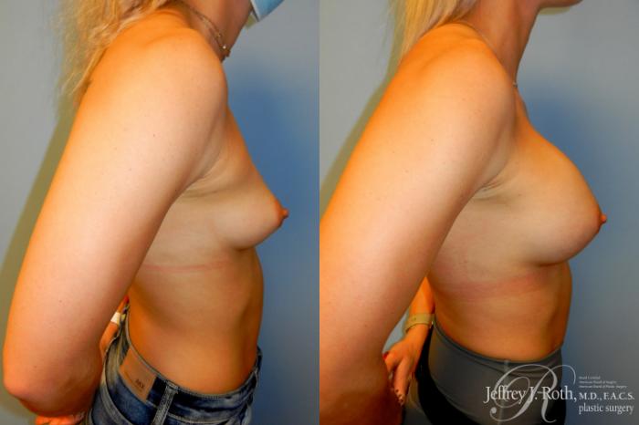 Before & After Breast Augmentation Case 239 Right Side View in Las Vegas, NV
