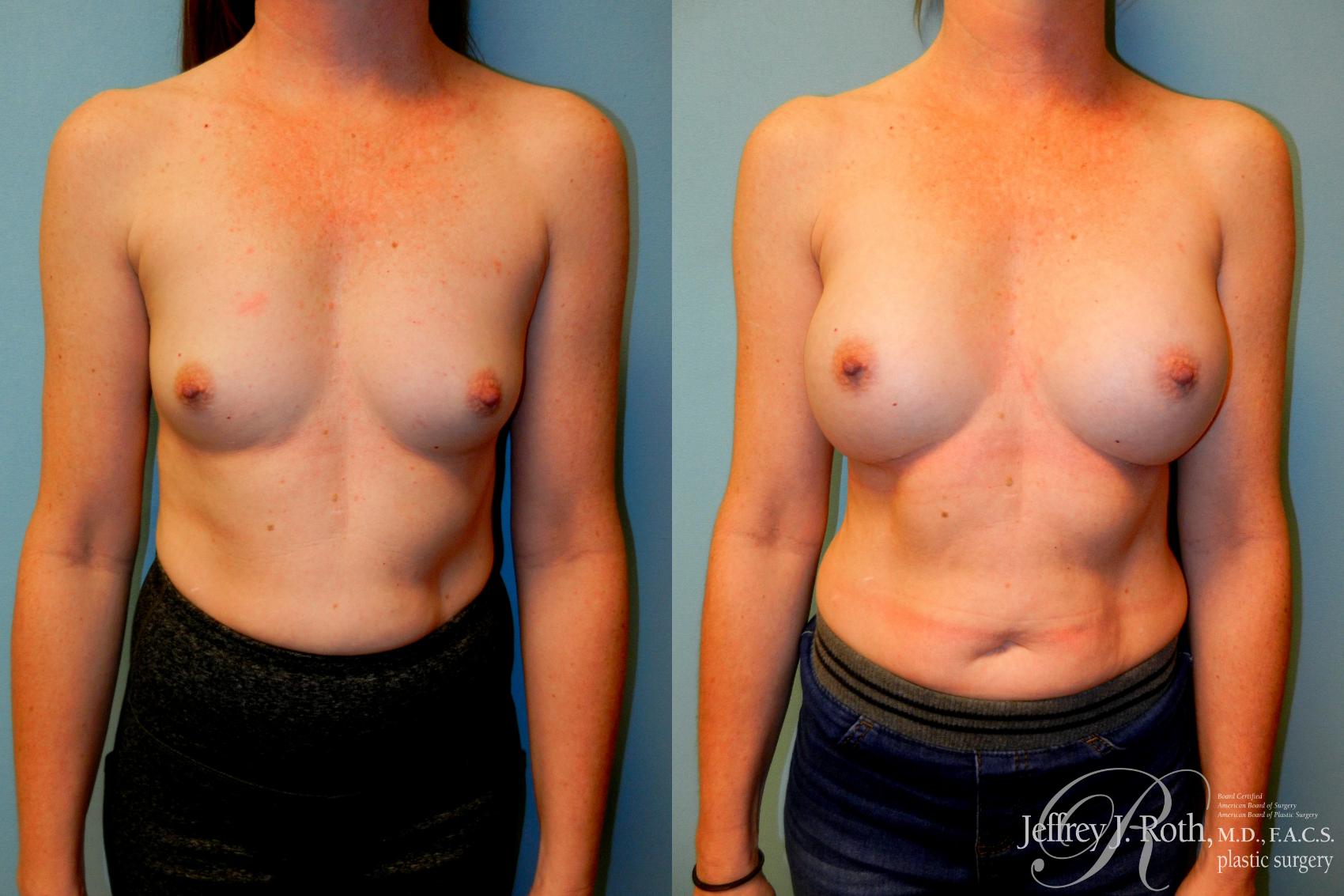 Before & After Breast Augmentation Case 245 Front View in Las Vegas and Henderson, NV