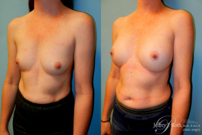 Before & After Breast Augmentation Case 245 Left Oblique View in Las Vegas and Henderson, NV