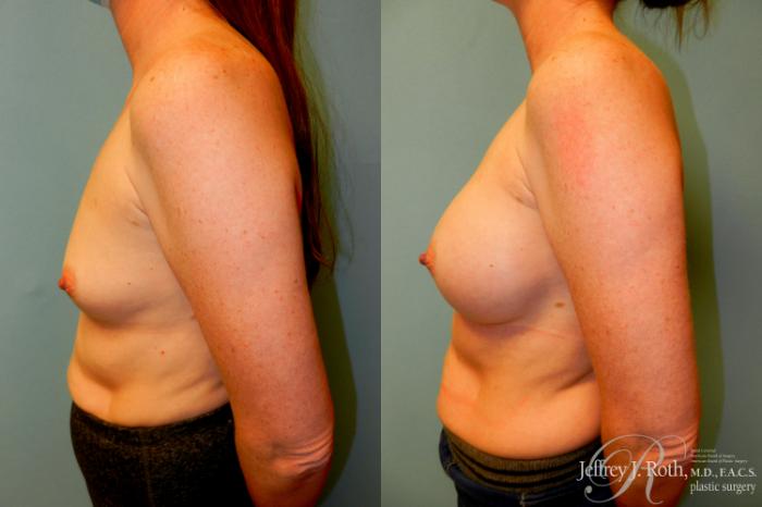 Before & After Breast Augmentation Case 245 Left Side View in Las Vegas and Henderson, NV