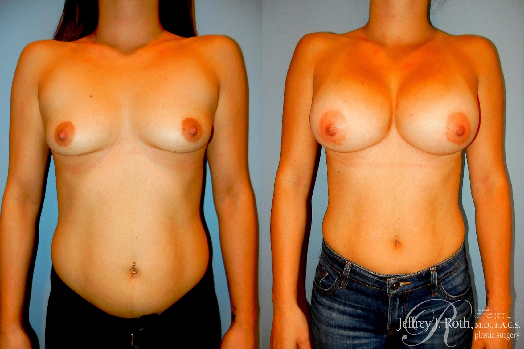 Before & After Breast Augmentation Case 297 Front View in Las Vegas and Henderson, NV