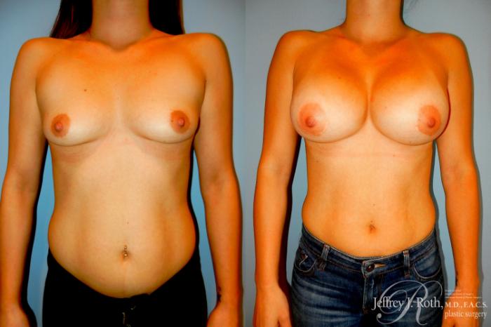 Before & After Breast Augmentation Case 297 Front View in Las Vegas and Henderson, NV