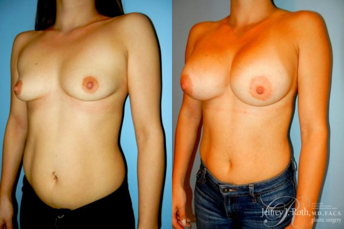 Before & After Breast Augmentation Case 297 Left Oblique View in Las Vegas and Henderson, NV
