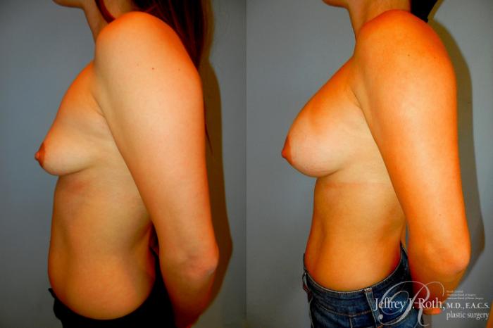 Before & After Breast Augmentation Case 297 Left Side View in Las Vegas and Henderson, NV