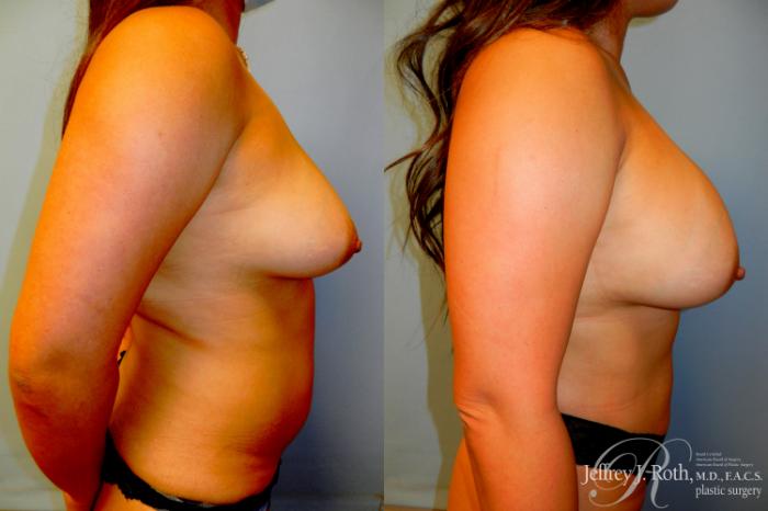 Before & After Breast Augmentation Case 306 Right Side View in Las Vegas and Henderson, NV