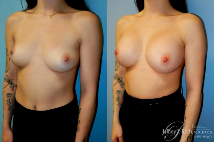 Before & After Breast Augmentation Case 310 Left Oblique View in Las Vegas and Henderson, NV