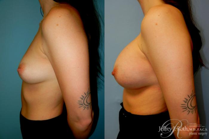 Before & After Breast Augmentation Case 310 Left Side View in Las Vegas and Henderson, NV