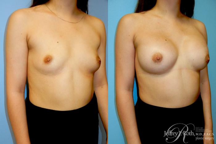 Before & After Breast Augmentation Case 324 Right Oblique View in Las Vegas and Henderson, NV