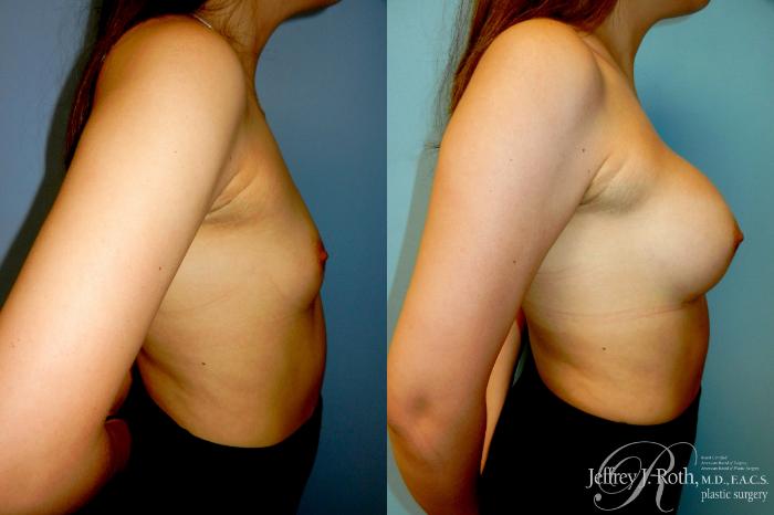 Before & After Breast Augmentation Case 324 Right Side View in Las Vegas and Henderson, NV