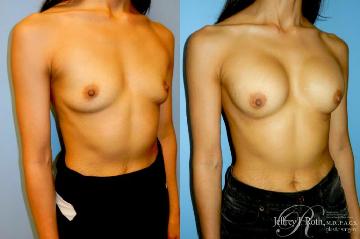 Before & After Breast Augmentation Case 340 Right Oblique View in Las Vegas and Henderson, NV