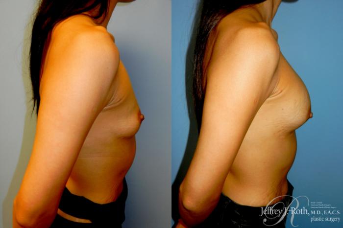 Before & After Breast Augmentation Case 340 Right Side View in Las Vegas and Henderson, NV