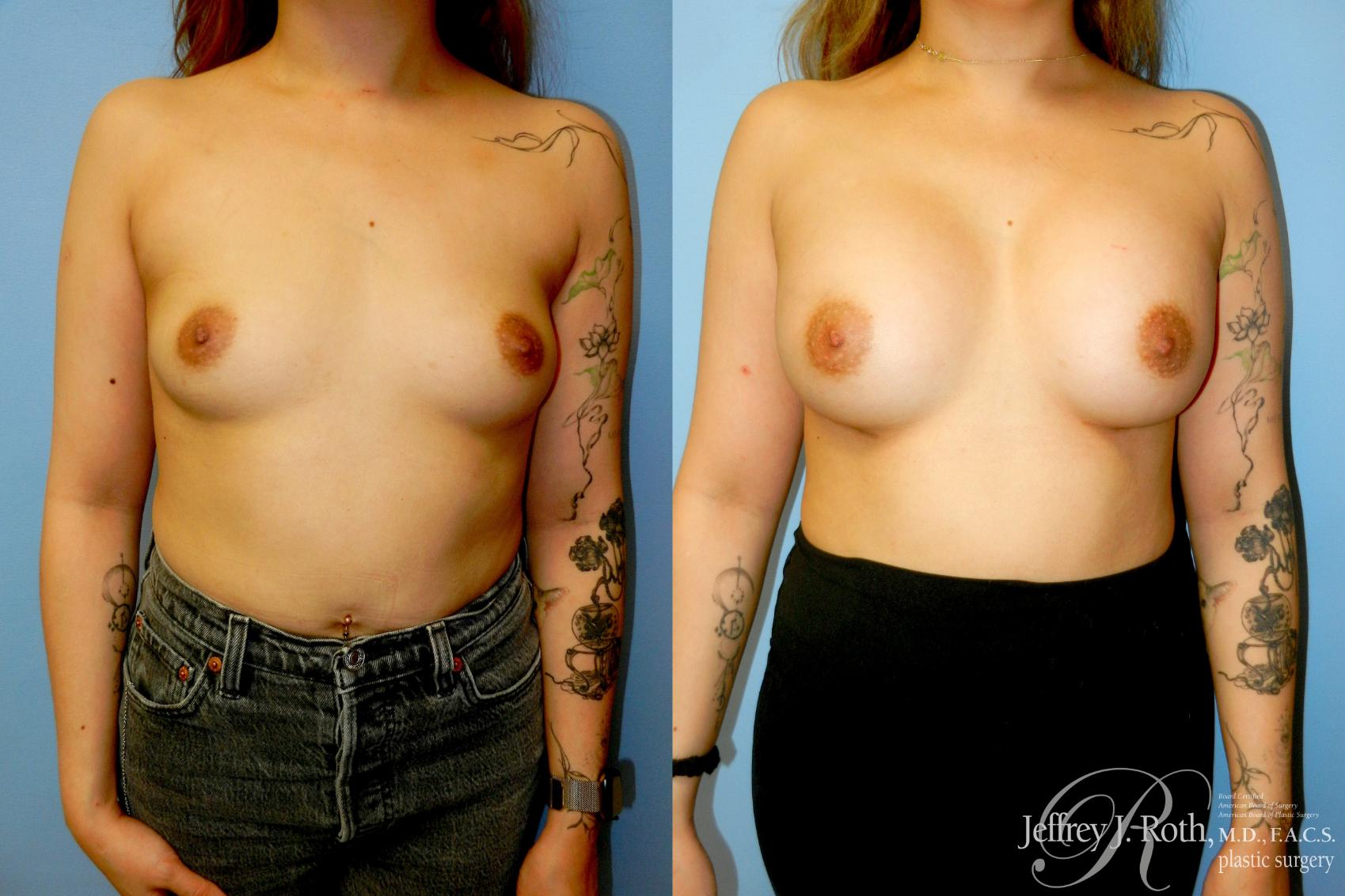 Before & After Breast Augmentation Case 341 Front View in Las Vegas and Henderson, NV