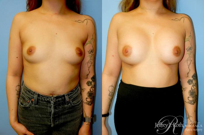 Before & After Breast Augmentation Case 341 Front View in Las Vegas and Henderson, NV