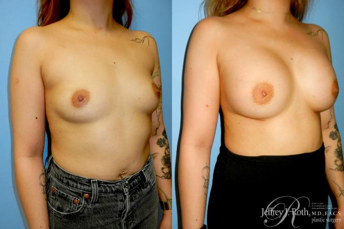 Before & After Breast Augmentation Case 341 Right Oblique View in Las Vegas and Henderson, NV