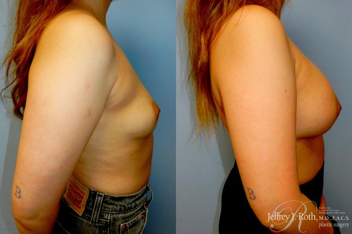 Before & After Breast Augmentation Case 341 Right Side View in Las Vegas and Henderson, NV