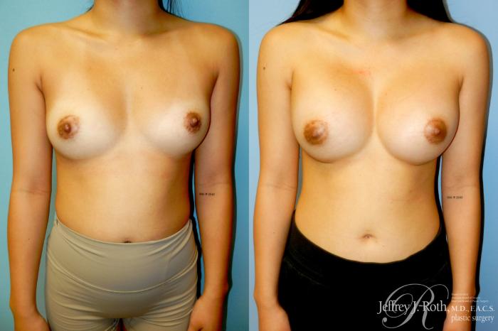 Before & After Breast Augmentation Case 342 Front View in Las Vegas and Henderson, NV