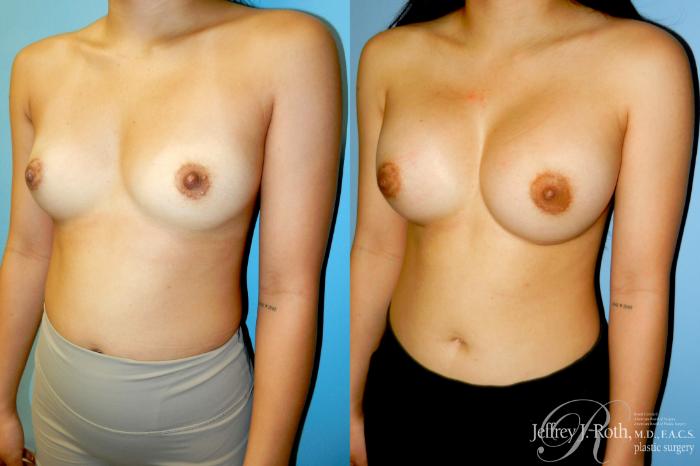 Before & After Breast Augmentation Case 342 Left Oblique View in Las Vegas and Henderson, NV