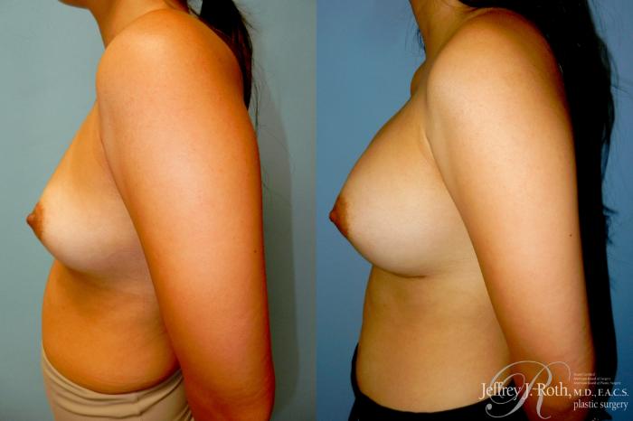 Before & After Breast Augmentation Case 342 Left Side View in Las Vegas and Henderson, NV