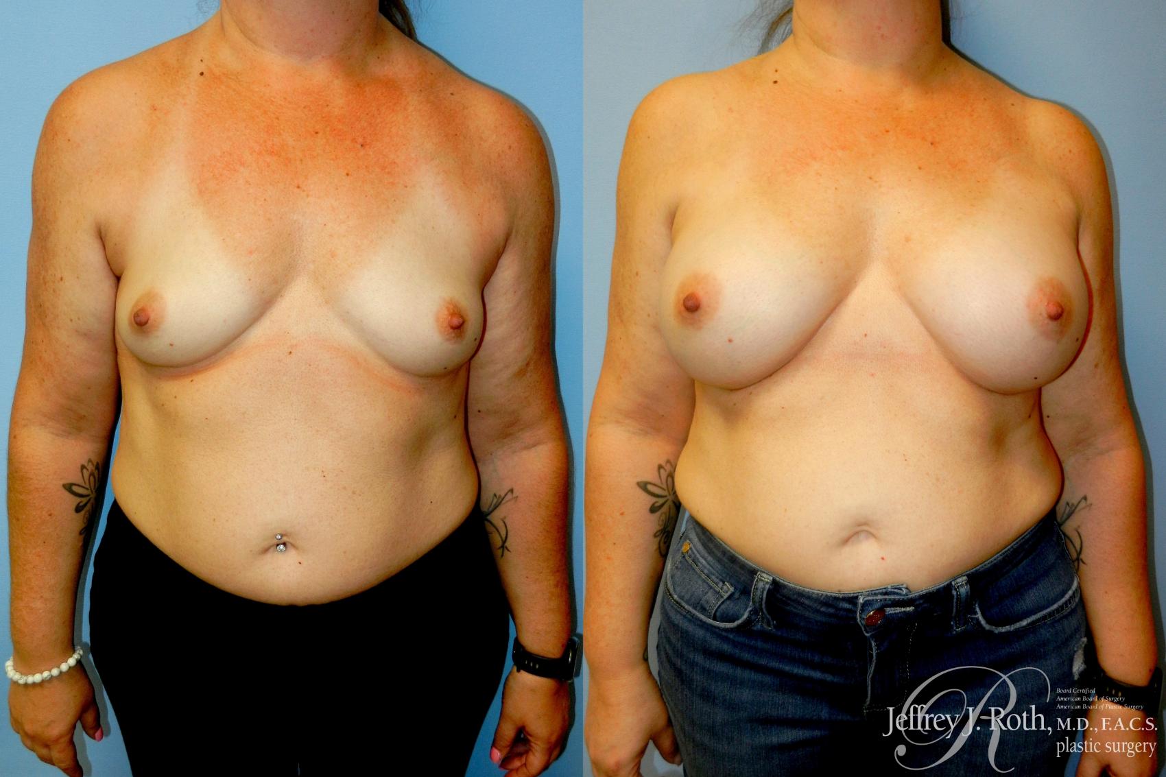 Before & After Breast Augmentation Case 347 Front View in Las Vegas and Henderson, NV