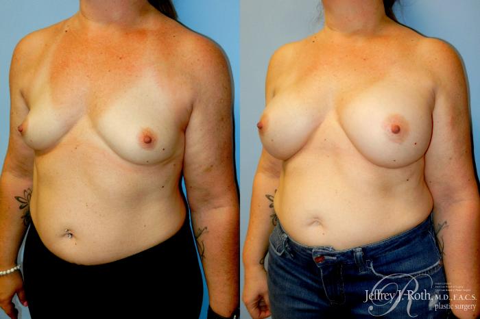 Before & After Breast Augmentation Case 347 Left Oblique View in Las Vegas and Henderson, NV